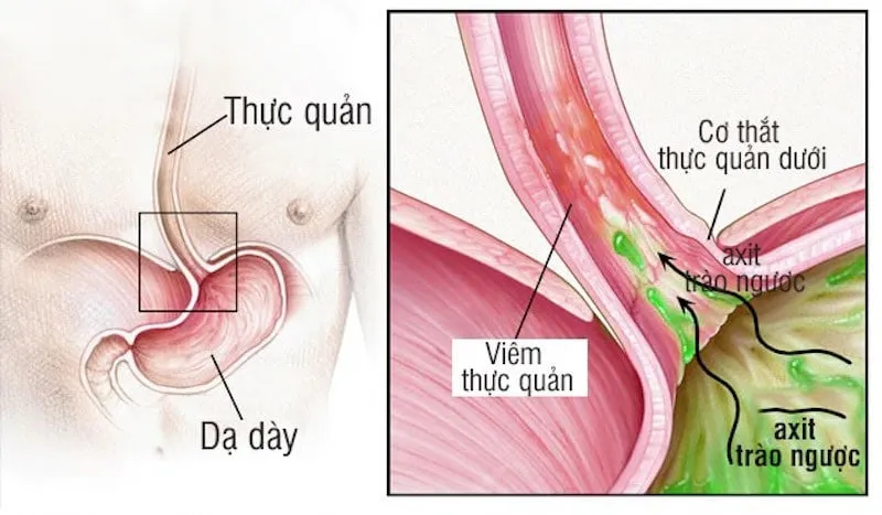 Bị đầy hơi khó thở: Làm sao để giảm triệu chứng này một cách hiệu quả