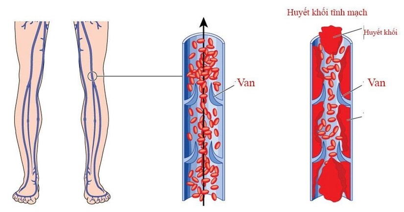 Nghẽn tĩnh mạch chân – Những điều cần biết để bảo vệ sức khỏe