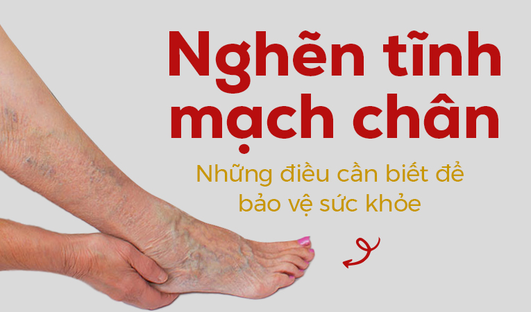 Nghẽn tĩnh mạch chân – Những điều cần biết để bảo vệ sức khỏe