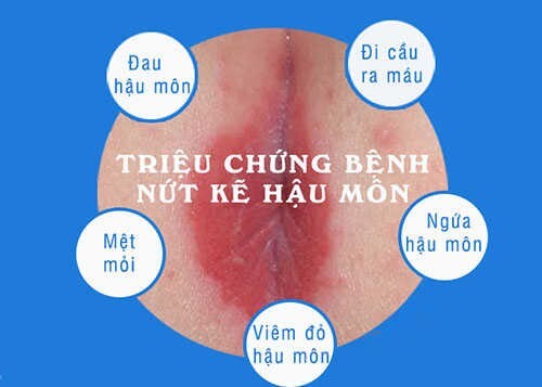 Nứt kẽ hậu môn phải làm sao? Biện pháp điều trị và phòng ngừa