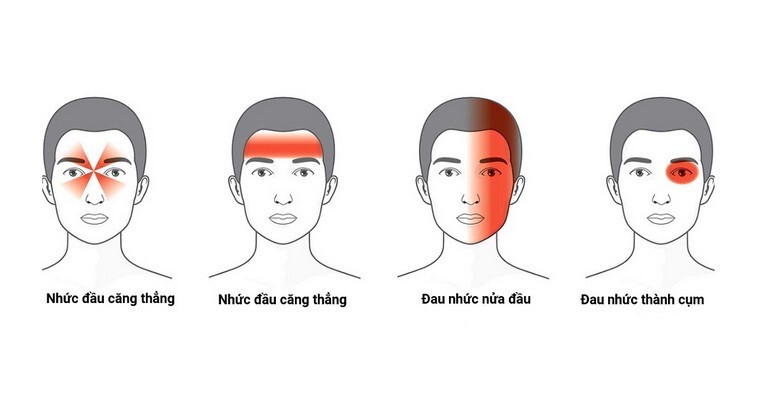 Mách bạn cách cải thiện tình trạng đau đầu khó ngủ