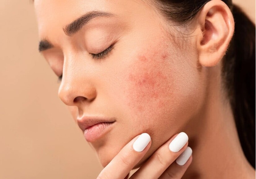 Da nhạy cảm dễ nổi mụn: Nguyên nhân và cách chăm sóc