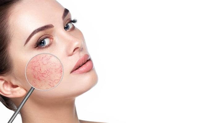 Da nhạy cảm dễ nổi mụn: Nguyên nhân và cách chăm sóc
