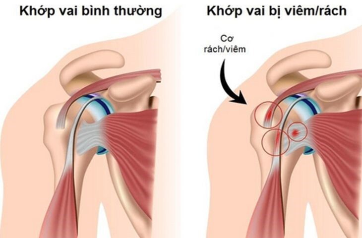 Làm thế nào để điều trị bệnh viêm khớp vai hiệu quả?