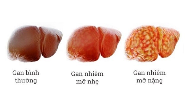 Gan nhiễm mỡ nhẹ: Những điều mà người bệnh cần biết