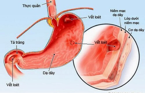 Chướng bụng trên: Mẹo giảm đầy hơi và cải thiện tiêu hóa