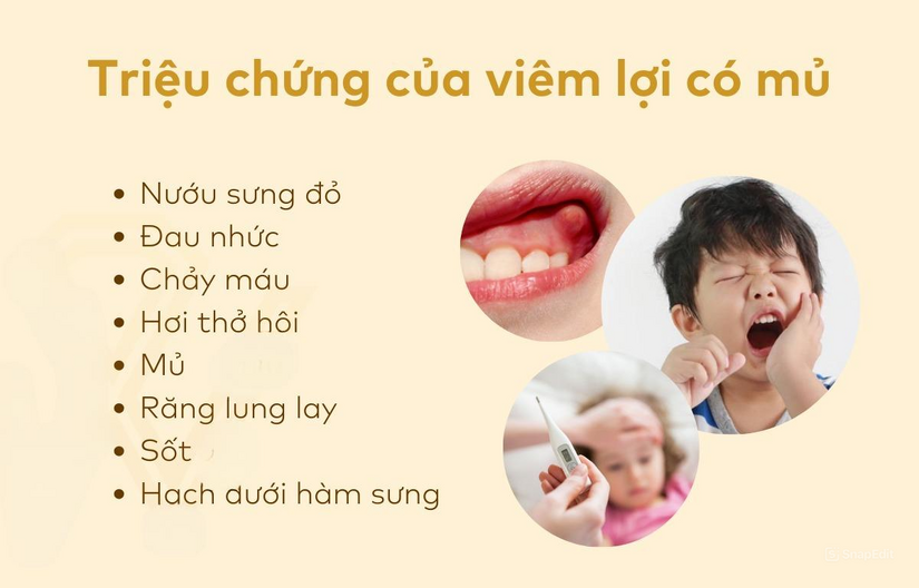 Viêm lợi có mủ trắng là bệnh gì? Cách nhận biết và khắc phục hiệu quả