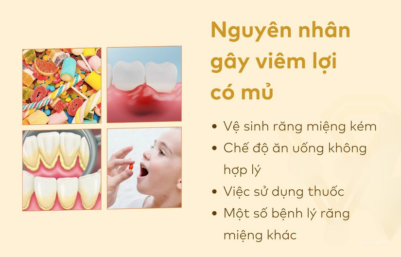 Viêm lợi có mủ trắng là bệnh gì? Cách nhận biết và khắc phục hiệu quả