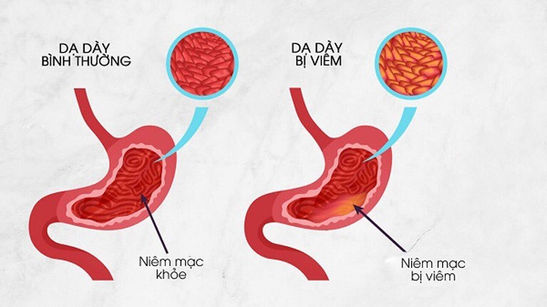 Giải đáp: Điều trị viêm dạ dày trong bao lâu?