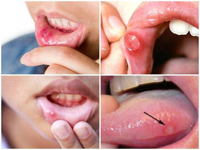 Nhiệt miệng ở trẻ em: Chỉ dẫn cách giảm đau và giảm viêm loét