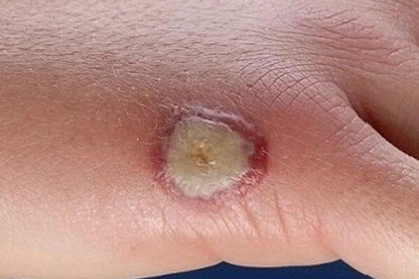 Làm thế nào để xử lý khi vết thương sưng mủ đau đớn?