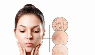Cách chăm sóc da hỗn hợp bị mụn, giúp làn da luôn khỏe đẹp