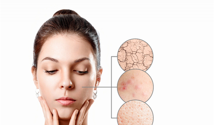 Cách chăm sóc da hỗn hợp bị mụn, giúp làn da luôn khỏe đẹp