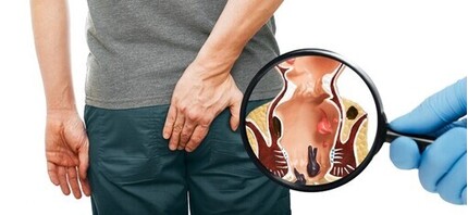 Trĩ hỗn hợp độ 2 có nguy hiểm không? Cách phòng ngừa và điều trị