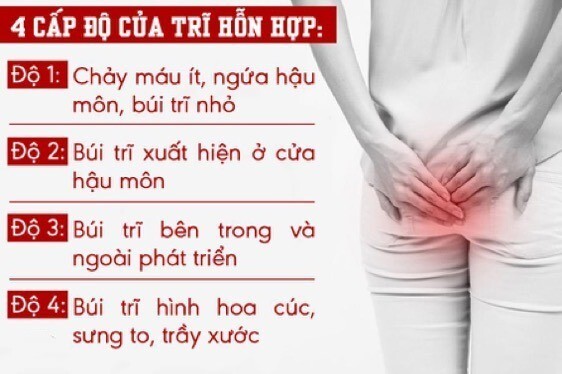 Trĩ hỗn hợp độ 2 có nguy hiểm không? Cách phòng ngừa và điều trị