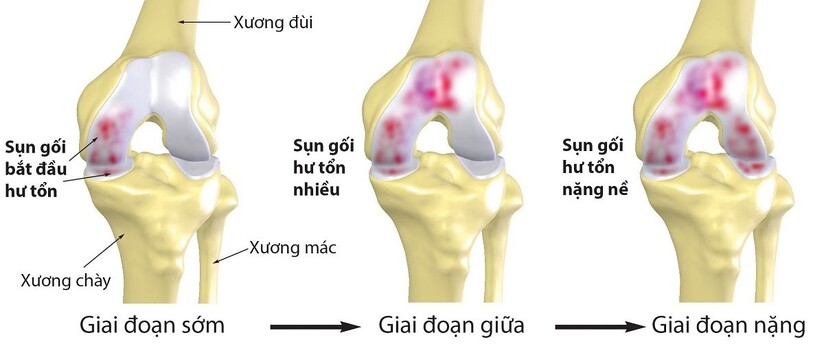 Viêm khớp gối kiêng ăn gì để ngăn ngừa tiến triển bệnh?