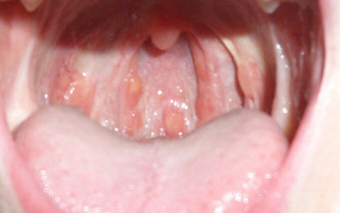 Loét vòm miệng do nhiệt miệng hay dấu hiệu bệnh lý nguy hiểm?