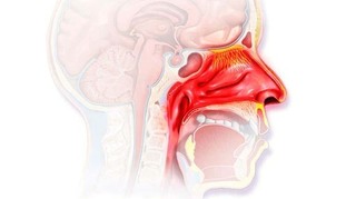Viêm mũi phù nề: Nguyên nhân và các biện pháp điều trị