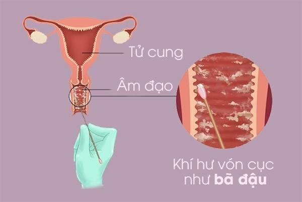 Khí hư như bã đậu có mùi tanh cảnh báo bệnh gì?