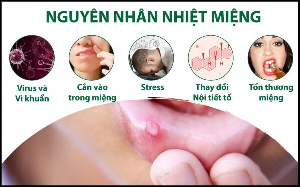 Nhiệt trong má, nhiệt miệng: Chỉ dẫn cách xử lý nhanh chóng