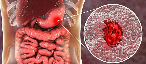 Viêm loét dạ dày có thể dẫn đến ung thư – Đừng chủ quan!