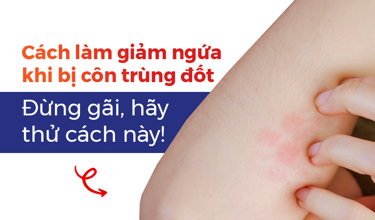 Cách làm giảm ngứa khi bị côn trùng đốt: Đừng gãi, hãy thử cách này!