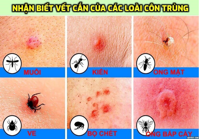 Cách làm giảm ngứa khi bị côn trùng đốt: Đừng gãi, hãy thử cách này!