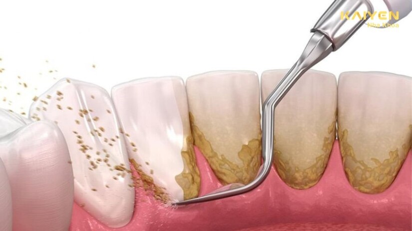 Tìm hiểu mối liên hệ và cách điều trị sâu răng viêm lợi