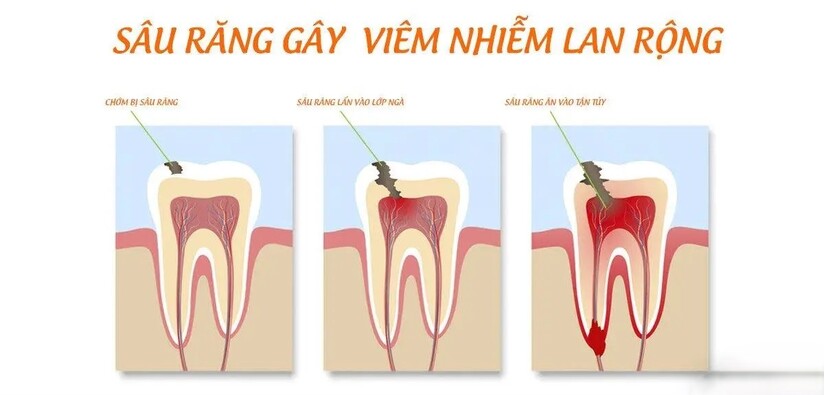 Tìm hiểu mối liên hệ và cách điều trị sâu răng viêm lợi