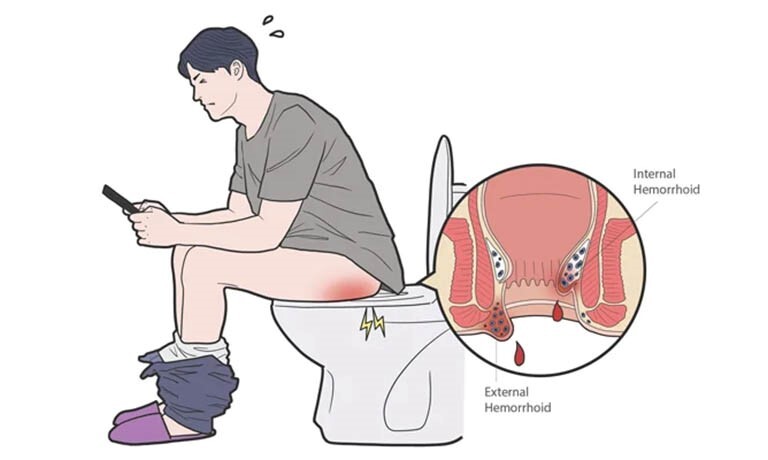Trĩ nội độ 1 – Chăm sóc và điều trị sớm để phòng biến chứng
