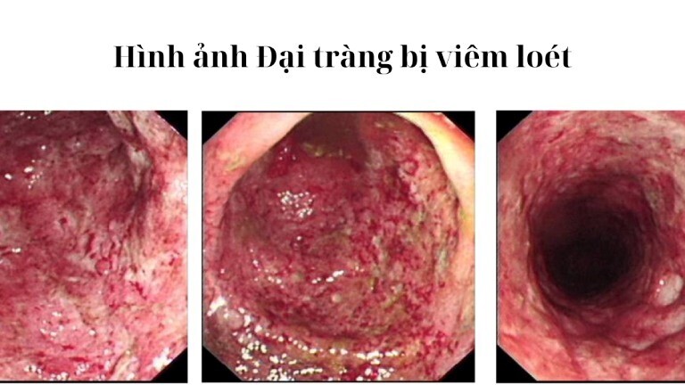7 dấu hiệu nhận biết sớm viêm loét đại tràng
