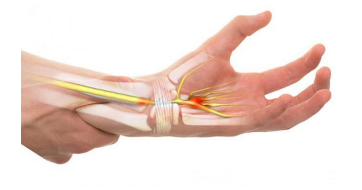 Đau khớp cổ tay là bệnh gì? Nguyên nhân và cách xử lý