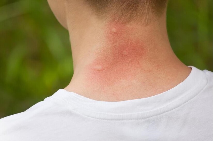 Chỉ dẫn cách xử lý vết côn trùng cắn sưng đỏ ngứa