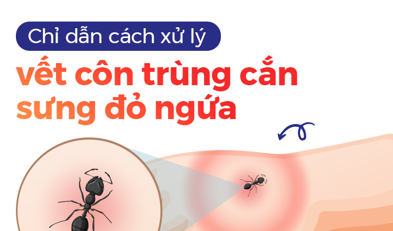 Chỉ dẫn cách xử lý vết côn trùng cắn sưng đỏ ngứa