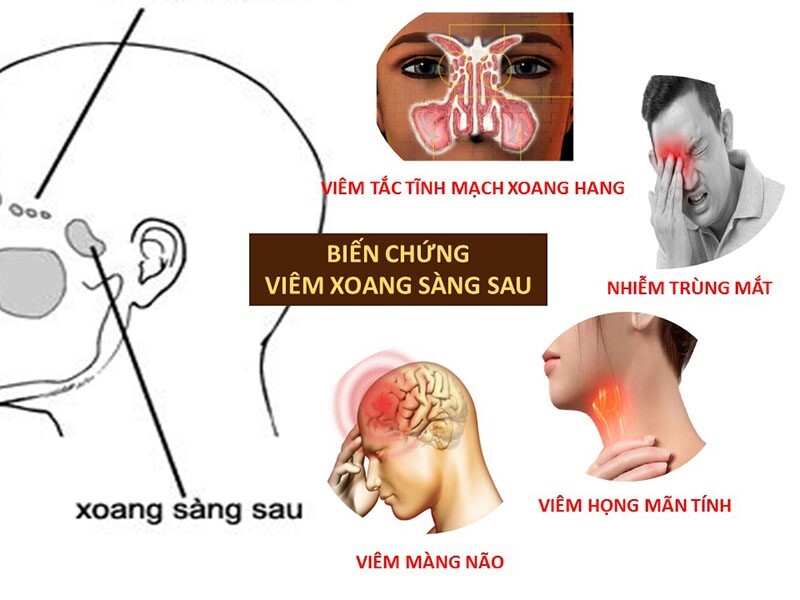 Viêm xoang sàng có nguy hiểm không? Giải đáp cho bạn