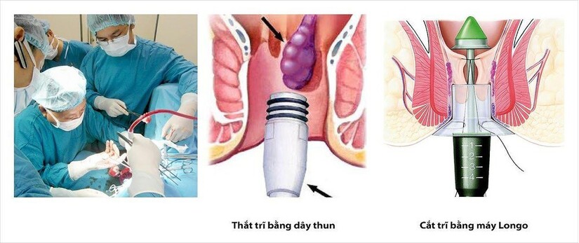 Giải đáp: Bệnh trĩ gây táo bón như thế nào?