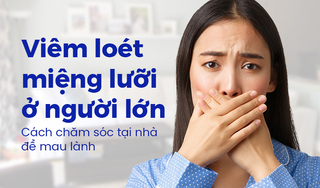Viêm loét miệng lưỡi ở người lớn: Cách chăm sóc tại nhà để mau lành