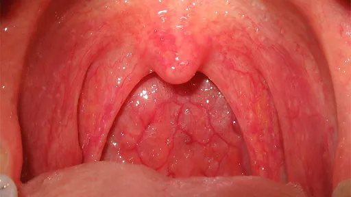 Cách xử trí tình trạng rát họng và ho có đờm