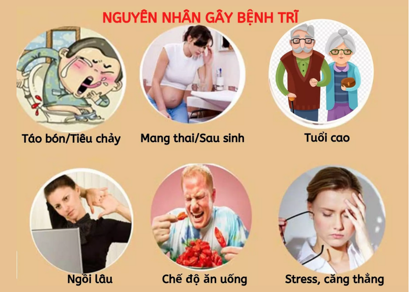 Bệnh trĩ nên kiêng gì để nhanh khỏi và tránh tái phát?