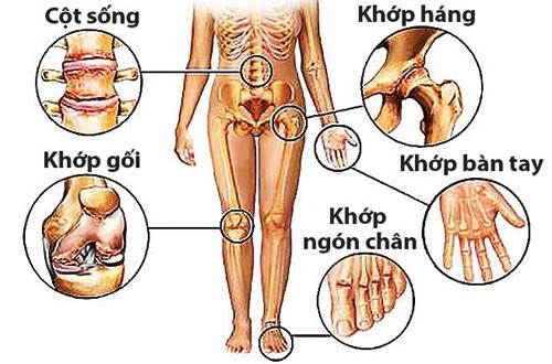 Điều trị viêm đa khớp ngay để tránh biến chứng nguy hiểm