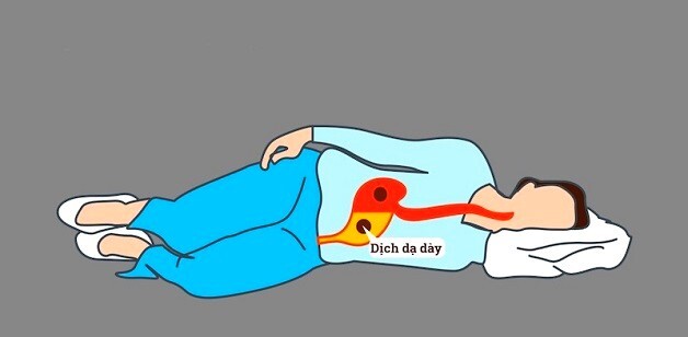 Làm gì khi thường xuyên trào ngược dạ dày ban đêm?