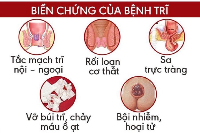 Búi trĩ sưng đau có nguy hiểm không? Điều trị như thế nào?