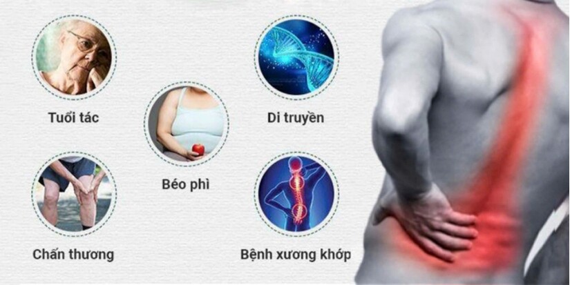 Gai cột sống là gì? Các phương pháp điều trị hiện nay