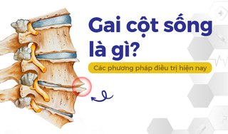 Gai cột sống là gì? Các phương pháp điều trị hiện nay