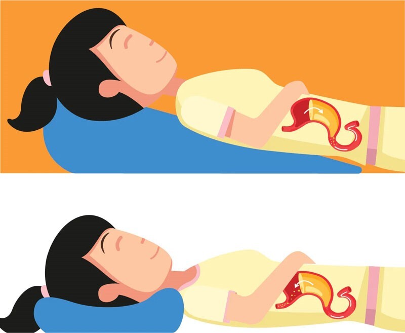 Trào ngược dạ dày phải làm sao? Mẹo giảm trào ngược tại nhà