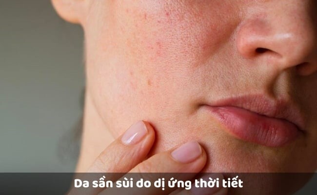Nguyên nhân khiến da bị mụn ẩn sần sùi kéo dài
