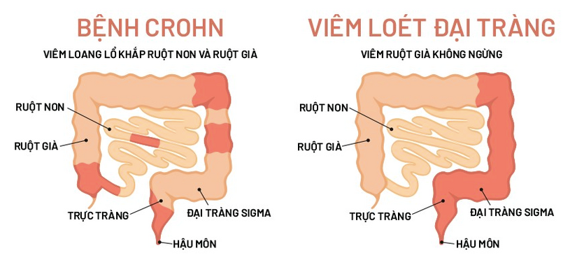 Hay đi ngoài nhiều lần trong ngày: Dấu hiệu cảnh báo bệnh gì?