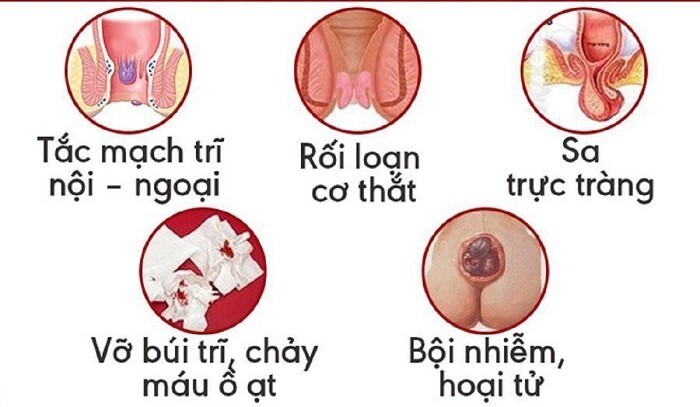 Búi trĩ ra máu nhiều có nguy hiểm không? Cách xử trí kịp thời