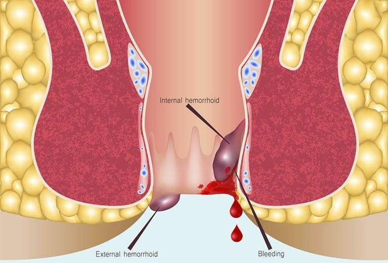 Búi trĩ ra máu nhiều có nguy hiểm không? Cách xử trí kịp thời