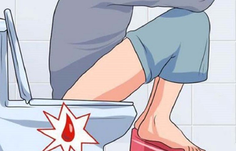 Đau trĩ cấp là tình trạng gì? Điều trị ra sao?